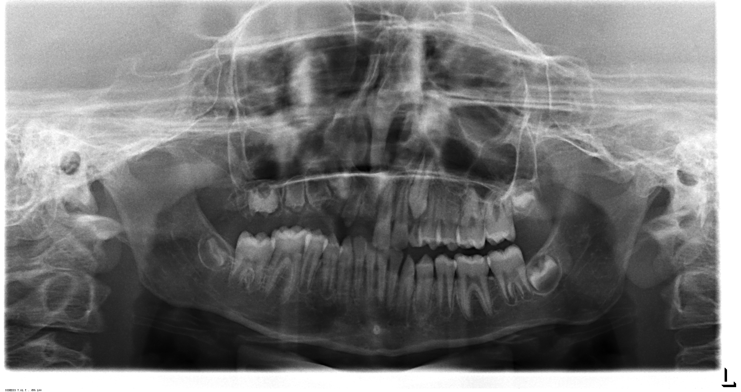 Unerupted Maxillary First Quadrant Teeth